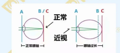 哪個年齡近視度數(shù)最容易增長？